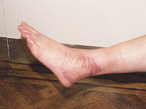 reddened ankle post-soak